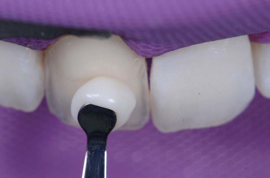 Fig. 8e Aplicação cuidadosa da resina respeitando a anatomia dentária.