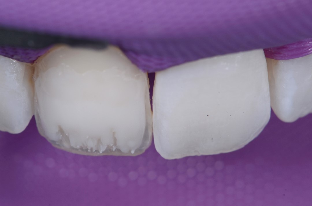 Fig. 8f Detalhe de toda parte dentinária confeccionada, estratificação e detalhes anatômicos confeccionados.