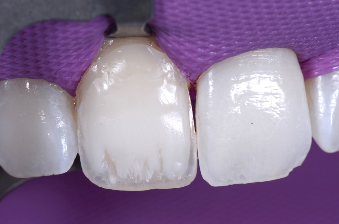 Fig. 8g Vista frontal da dentina confeccionada. 
