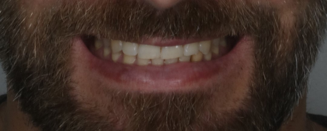 Fig. 1 – Sorriso inicial forçado, paciente reclamava que não conseguia mostrar muito os dentes e que os mesmos não apareciam em fotos