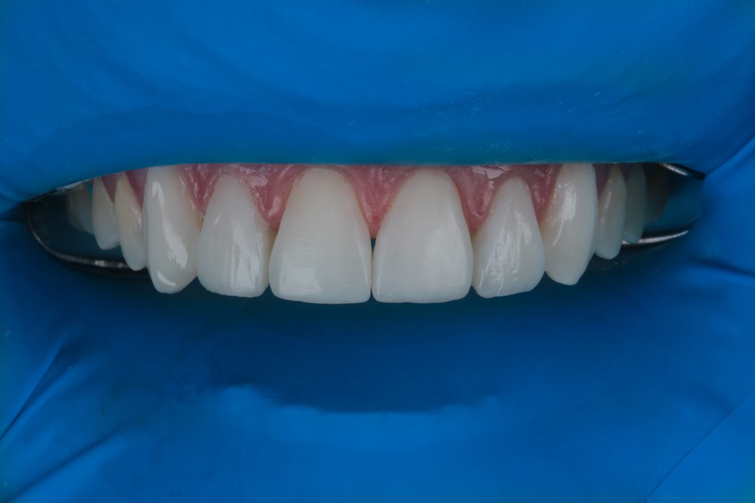 Fig. 14 – Resultado da primeira consulta onde foram realizados os 6 dentes ântero-superiores.