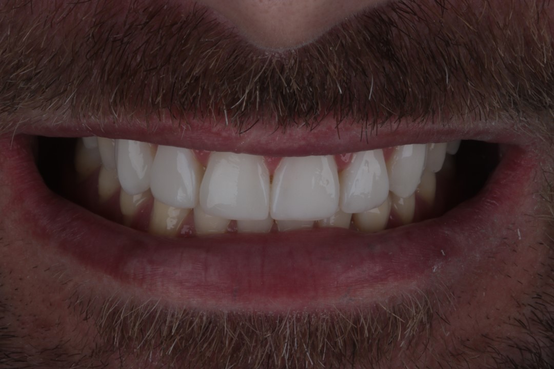 Fig. 15 – Resultado Intrabucal final, após a segunda consulta, onde foram realizadas as facetas dos pré-molares.