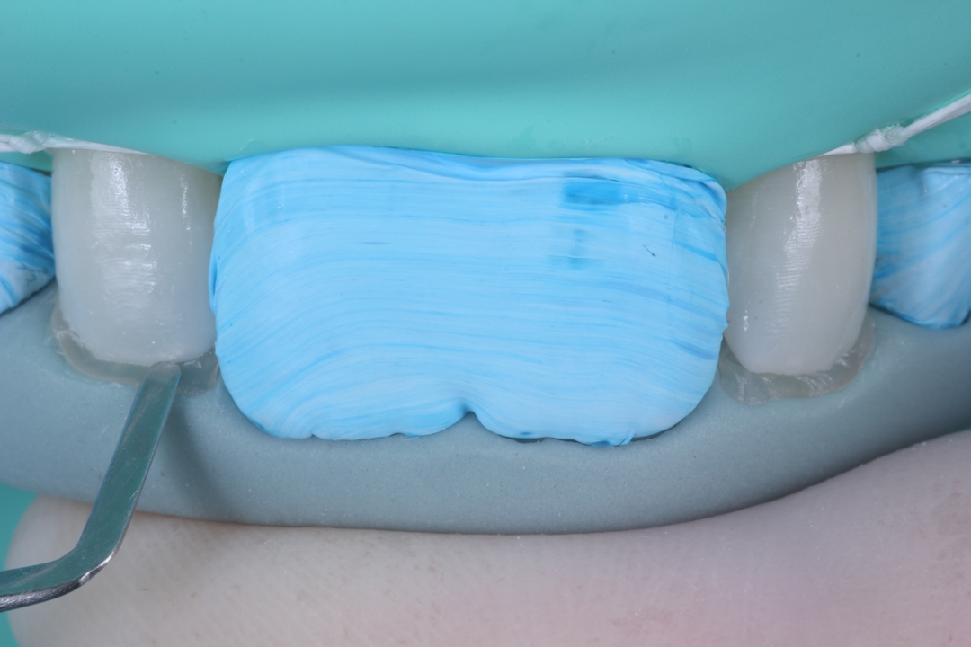 Fig. 11 - Posicionamento da guia de silicone, com a resina aplicada na face palatina dos dentes 12 e 22, na coloração Trans N.