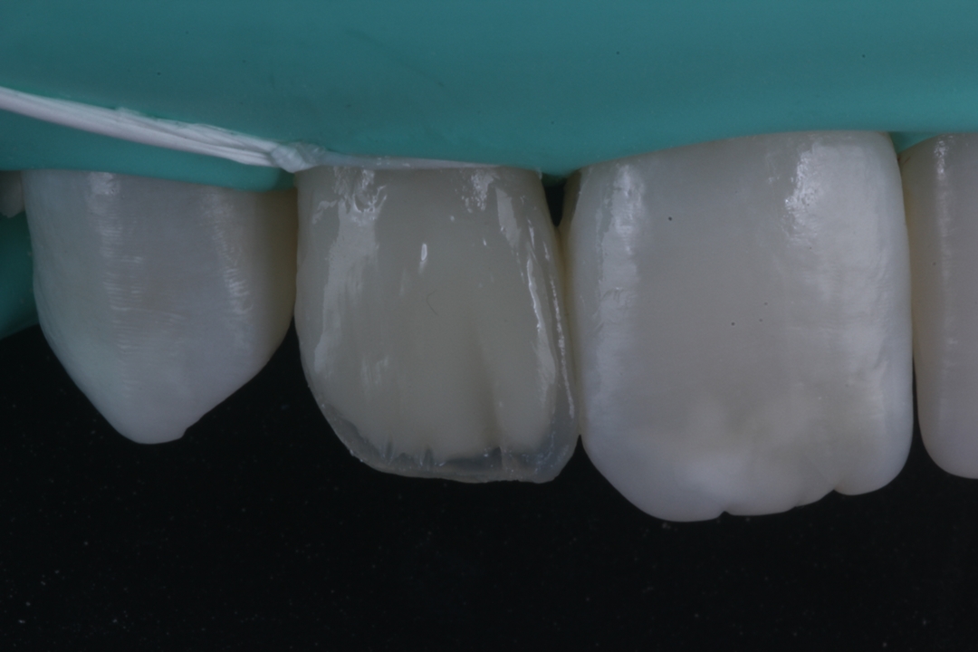 Fig. 13 - Aplicação da camada de dentina na cor DA0.