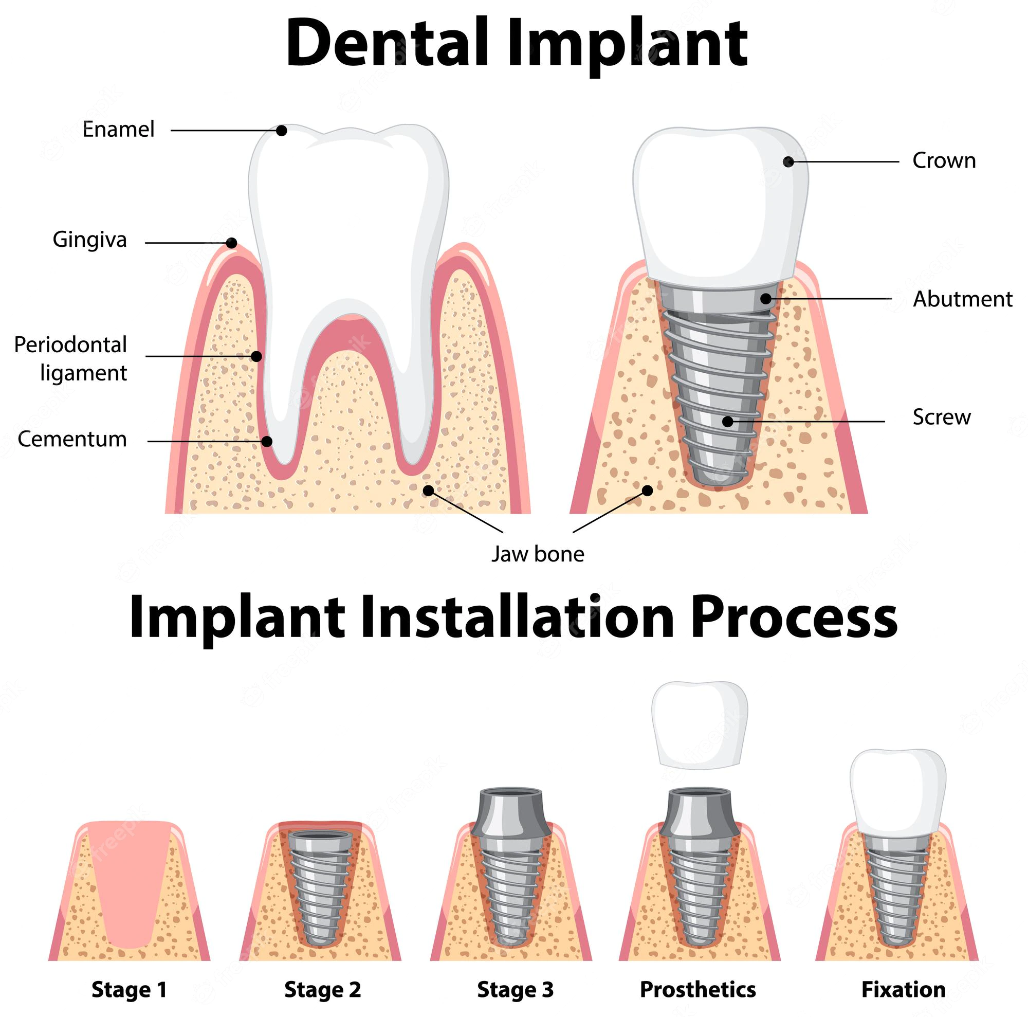 infographic human structure dental implant 1308 92721 - Transforme seu sorriso com implantes dentários: Um Guia Passo a Passo