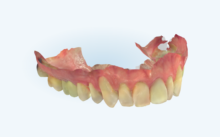 Captura de Tela 2022 07 18 as 20.18.17 e1684841148555 - Uso de implante friccional em carga imediata pós fratura dentária