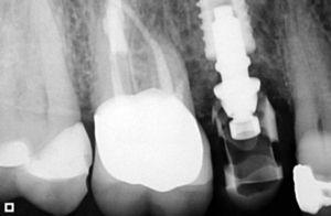 Controle 6o dias - Use of frictional implant in immediat load after dental fracture