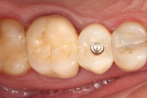 IMG 0529 - Use of frictional implant in immediat load after dental fracture