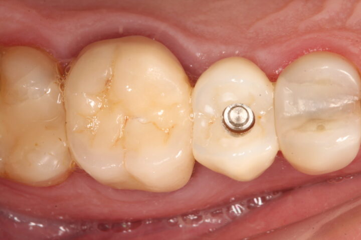 IMG 0529 scaled e1696594098203 - Uso de implante friccional em carga imediata pós fratura dentária