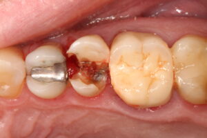 Dente fraturado