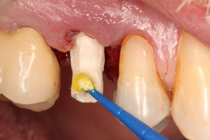 IMG 9158 scaled e1696593922953 - Uso de implante friccional em carga imediata pós fratura dentária