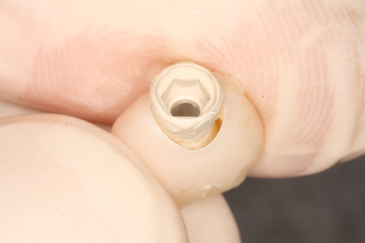 IMG 9159 scaled e1696593909709 - Uso de implante friccional em carga imediata pós fratura dentária