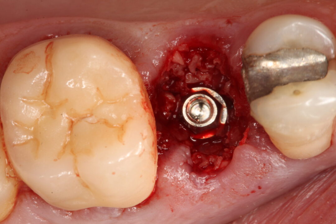 IMG 9162 scaled e1696593876562 - Uso de implante friccional en carga inmediata post rotura dentaria
