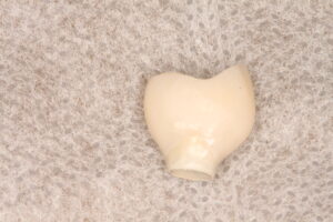 IMG 9164 - Uso de implante friccional en carga inmediata post rotura dentaria