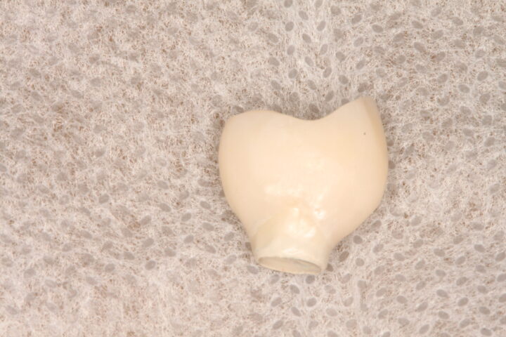 IMG 9164 scaled e1696593940936 - Uso de implante friccional em carga imediata pós fratura dentária