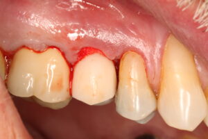 IMG 9169 - Use of frictional implant in immediat load after dental fracture