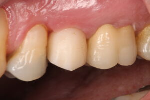 IMG 9274 - Use of frictional implant in immediat load after dental fracture