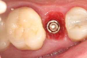 IMG 9923 - Use of frictional implant in immediat load after dental fracture