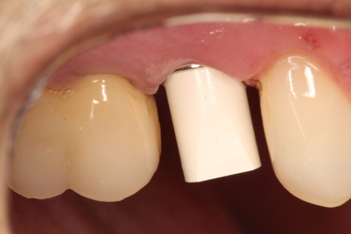 IMG 9927 scaled e1696594071885 - Uso de implante friccional em carga imediata pós fratura dentária
