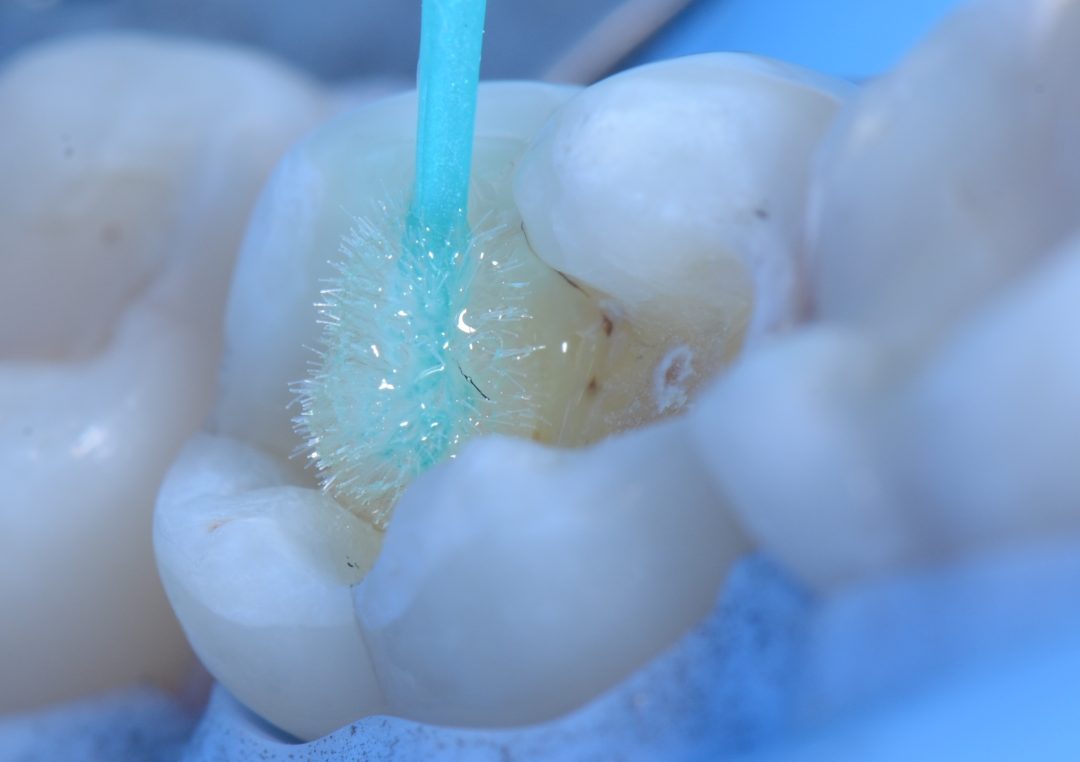 Fig. 4b – Application of Ambar Universal APS to dry dentin with the self-etching technique. Note the translucent aspect due to the APS technology. 