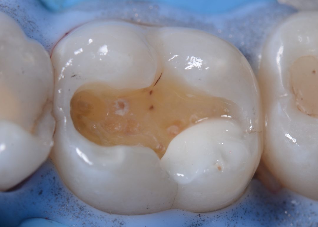 Fig. 6b – Occlusal view of the composite increment and the opaque white color. 