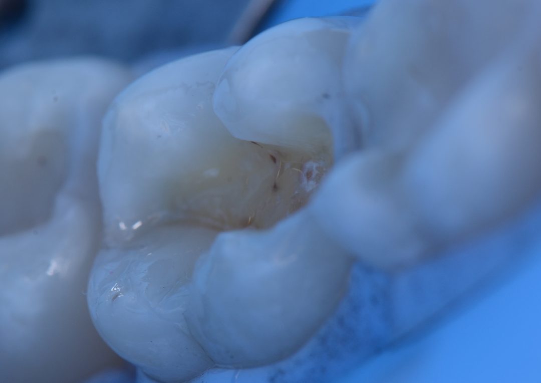 Fig. 6f – Detail of the composite integration after photoactivation.