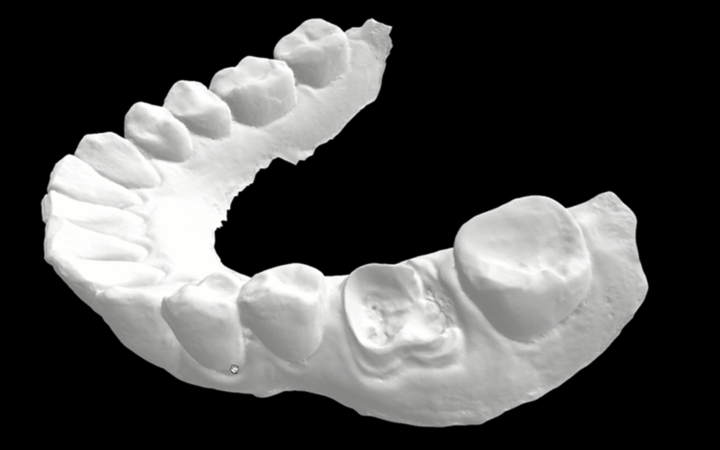 1 - Imagem-do-escaneamento-intra-oral-(pré-operatória)