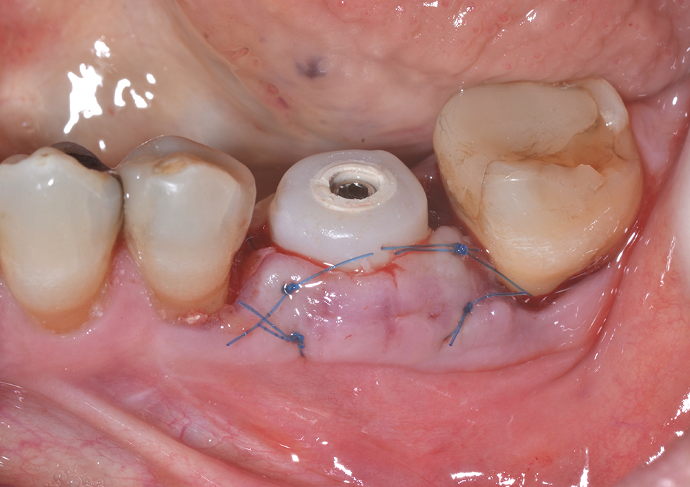 15 | Enxerto do tecido conjuntivo autógeno e suturas finais.