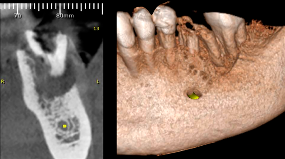 2.1 e 2.2 | Cortes tomográficos do dente 36 e reconstrução 3D