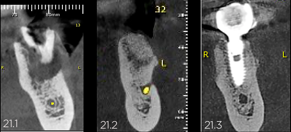 21.1 | Lesão óssea avançada. Fratura dentária. 21.2 | Regeneração óssea com Nanosynt. 21.3 | Reabilitação concluída. Implante Arcsys e coroa cerâmica.