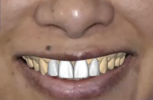 Escaneado y fotografías de la paciente para el enceramiento digital de la sonrisa, siguiendo la proporcionalidad de la cara y su personalidad.