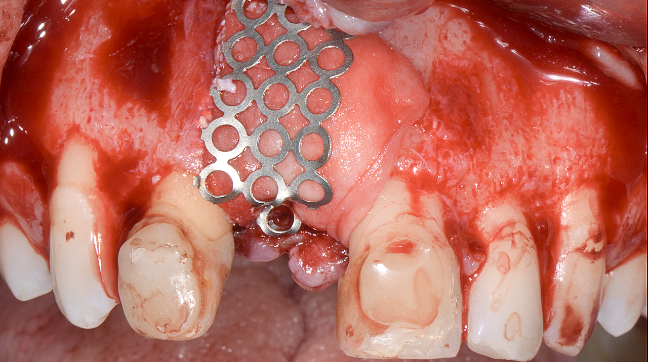 4 | Tela fixada por parafusos na vestibular e palatina, estabilizando o PRF BLOCK (recoberto por membrana).
