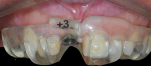 Pasados 6 meses, un implante guiado de la Cirugía Guiada Arcsys (CGA). Como fue obtenido un torque de 45 N.cm, se posibilitó la instalación de prótesis provisoria sobre el implante.