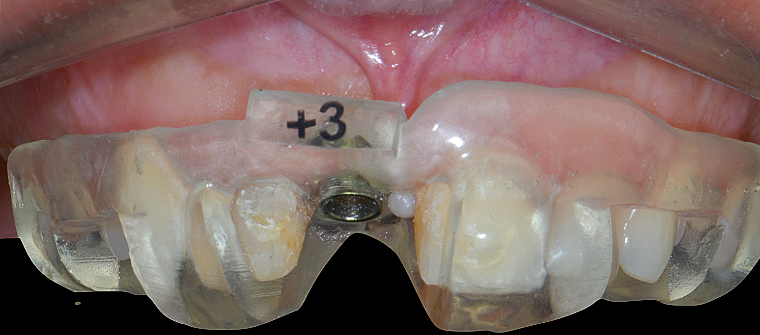 8 | Passados 6 meses, um implante guiado da Cirurgia Guiada Arcsys (CGA). Como foi obtido um torque de 45 N.cm, possibilitou-se a instalação de prótese provisória sobre o implante.