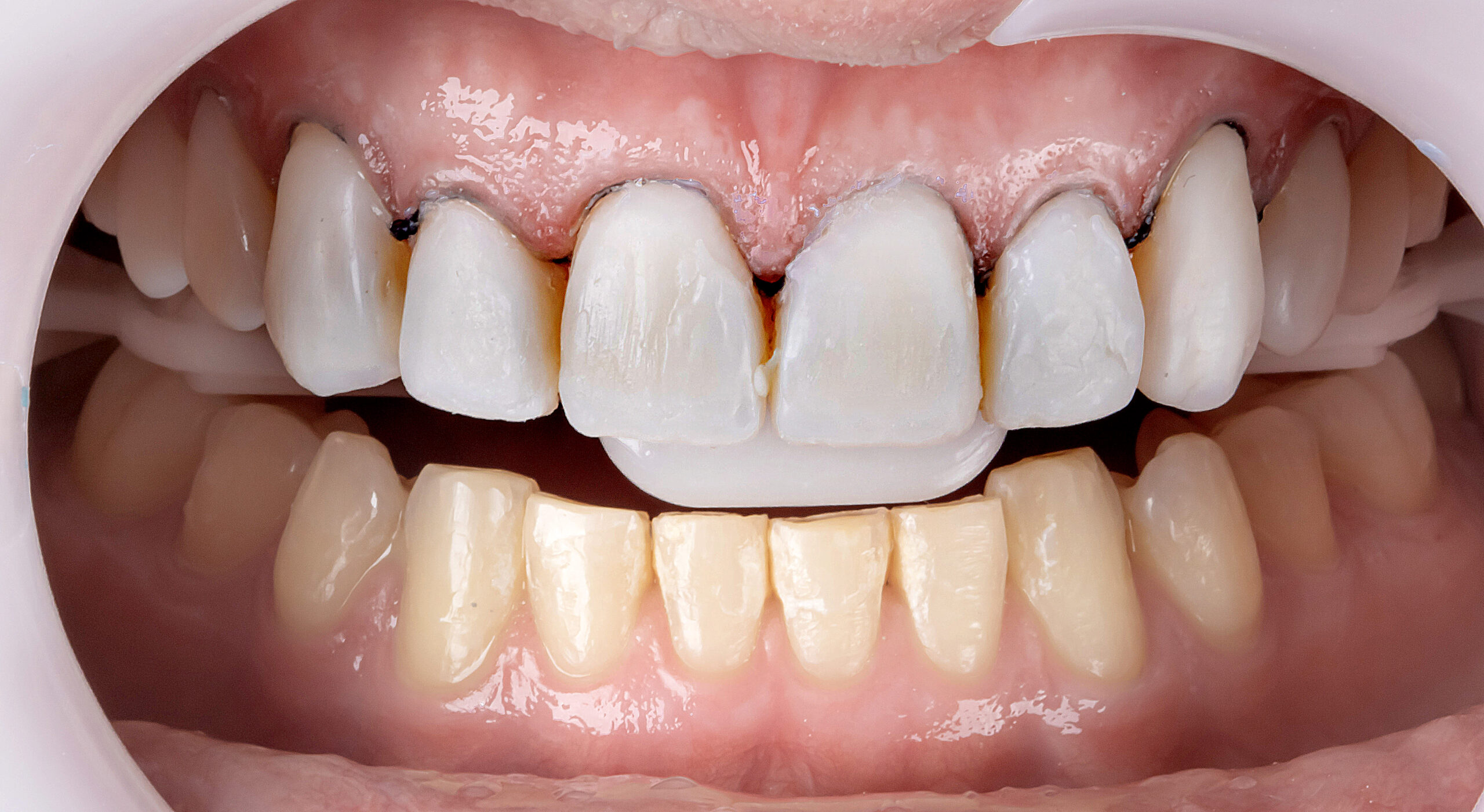 15 | Finalização dos demais elementos dentais com a mesma sequência de cores. 