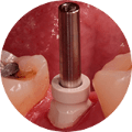 1ghli353utz - Arcsys Implant System