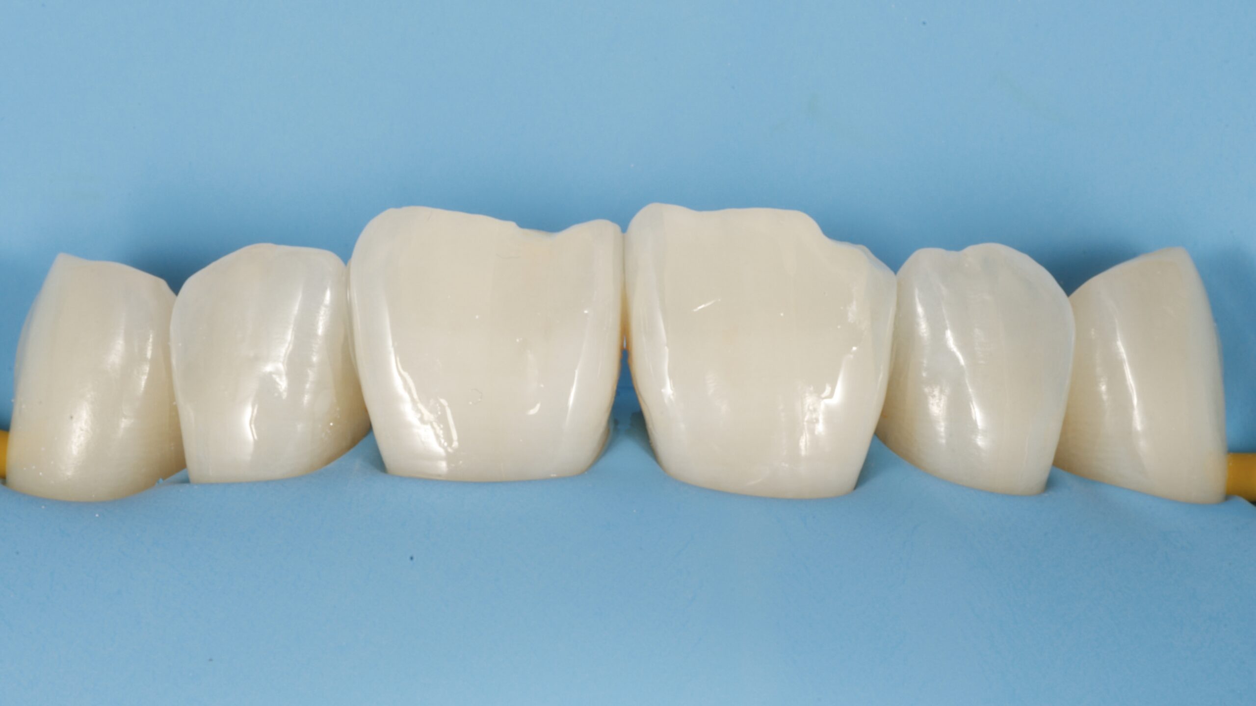 9 | Los dientes están debidamente grabados y el adhesivo no se percibe. Es una situación óptima para comenzar.