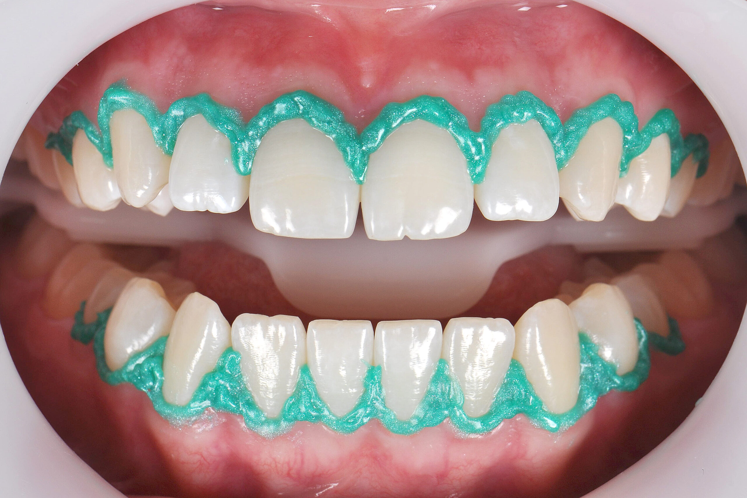 4 | Labial retractor in position and application of the Top dam Green gingival barrier.