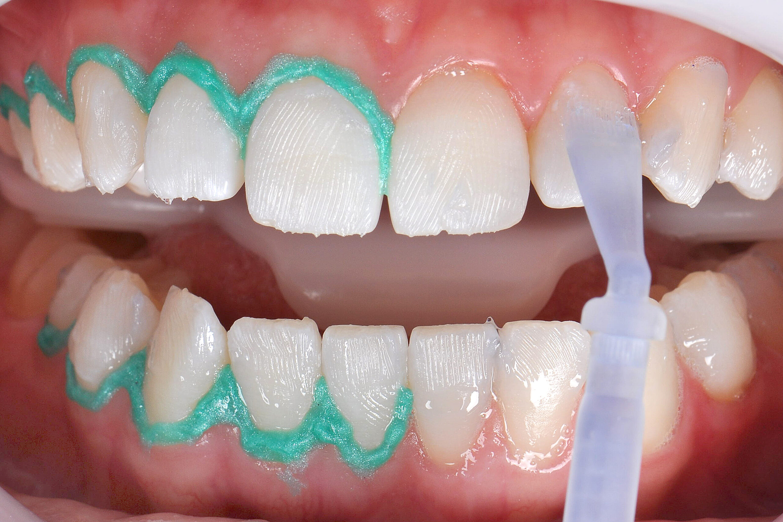 7 | Demonstration of not using the gingival barrier for Whiteness HP AutoMixx 6%.