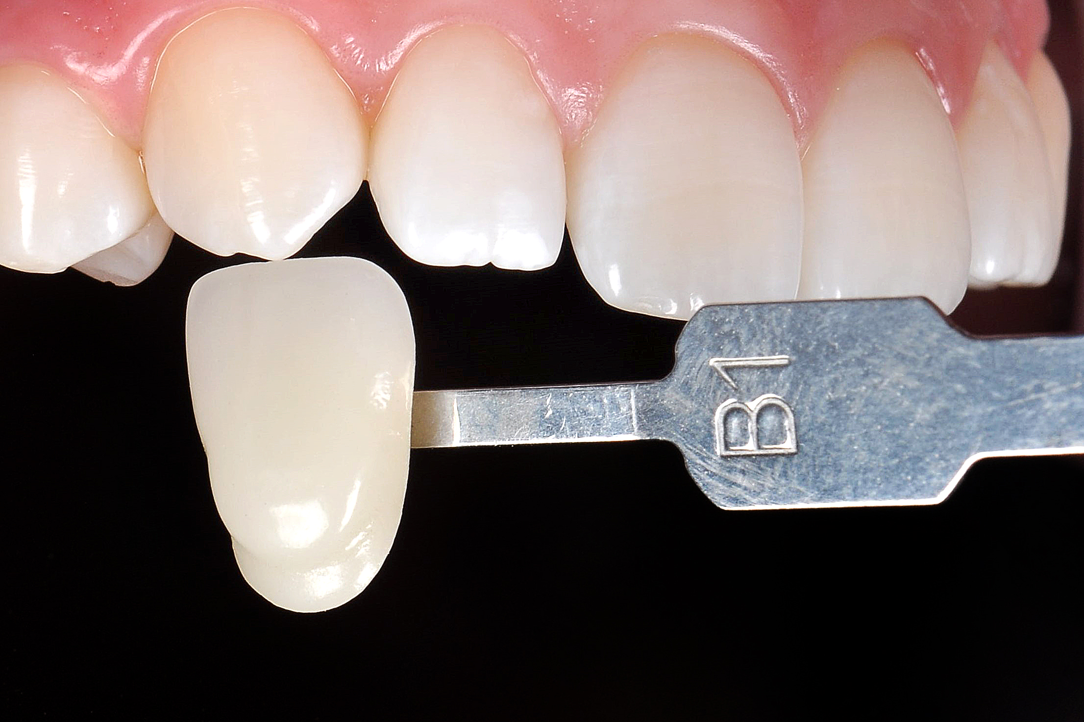 8 | Registration of the final shade, after 1 month of the whitening procedure.