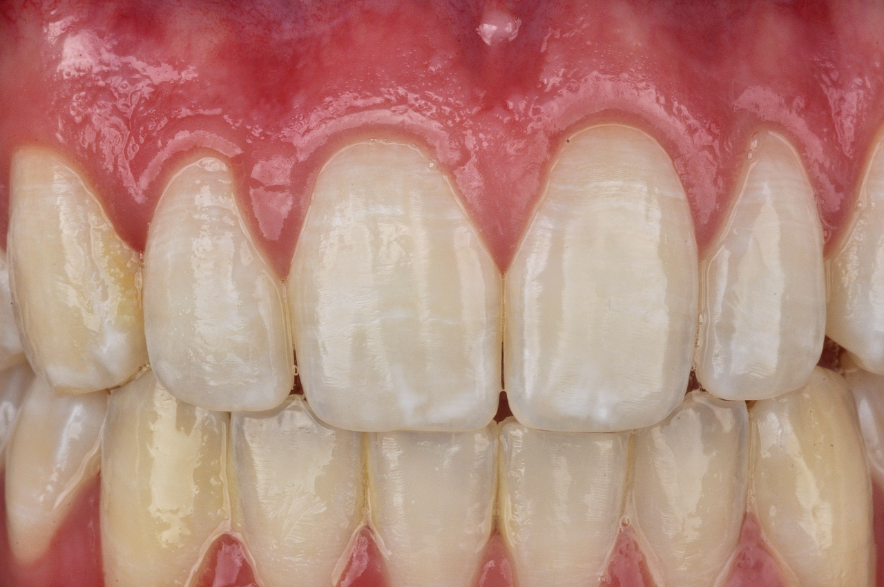 4 | Detalle de las manchas de fluorosis presentes en la estructura dental.