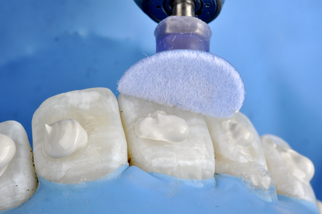 8 | Después del procedimiento de microabrasión, se hizo el pulido de la superficie de los dientes con la pasta Diamond Excel Ultrafine.