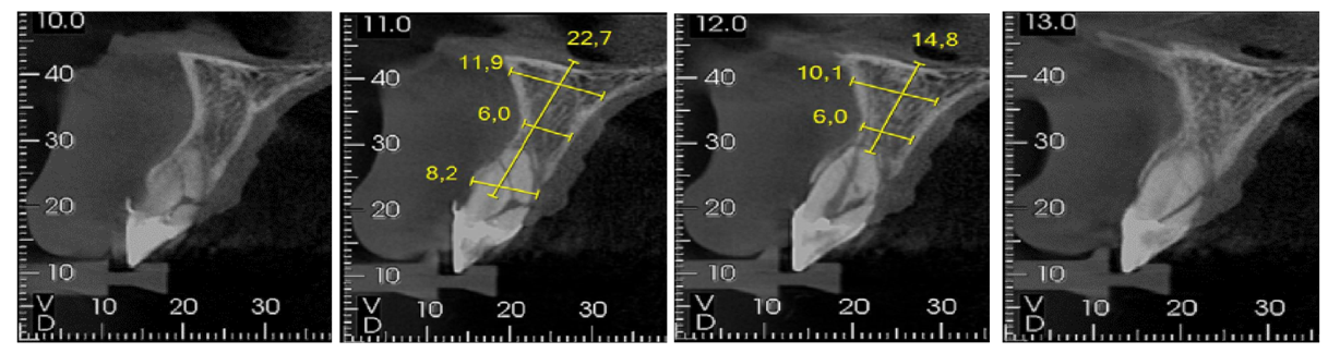 1 | A tábua óssea vestibular se encontrava fraturada e inserida no fragmento radicular, levando o paciente a perda da estrutura óssea de suporte vestibular.