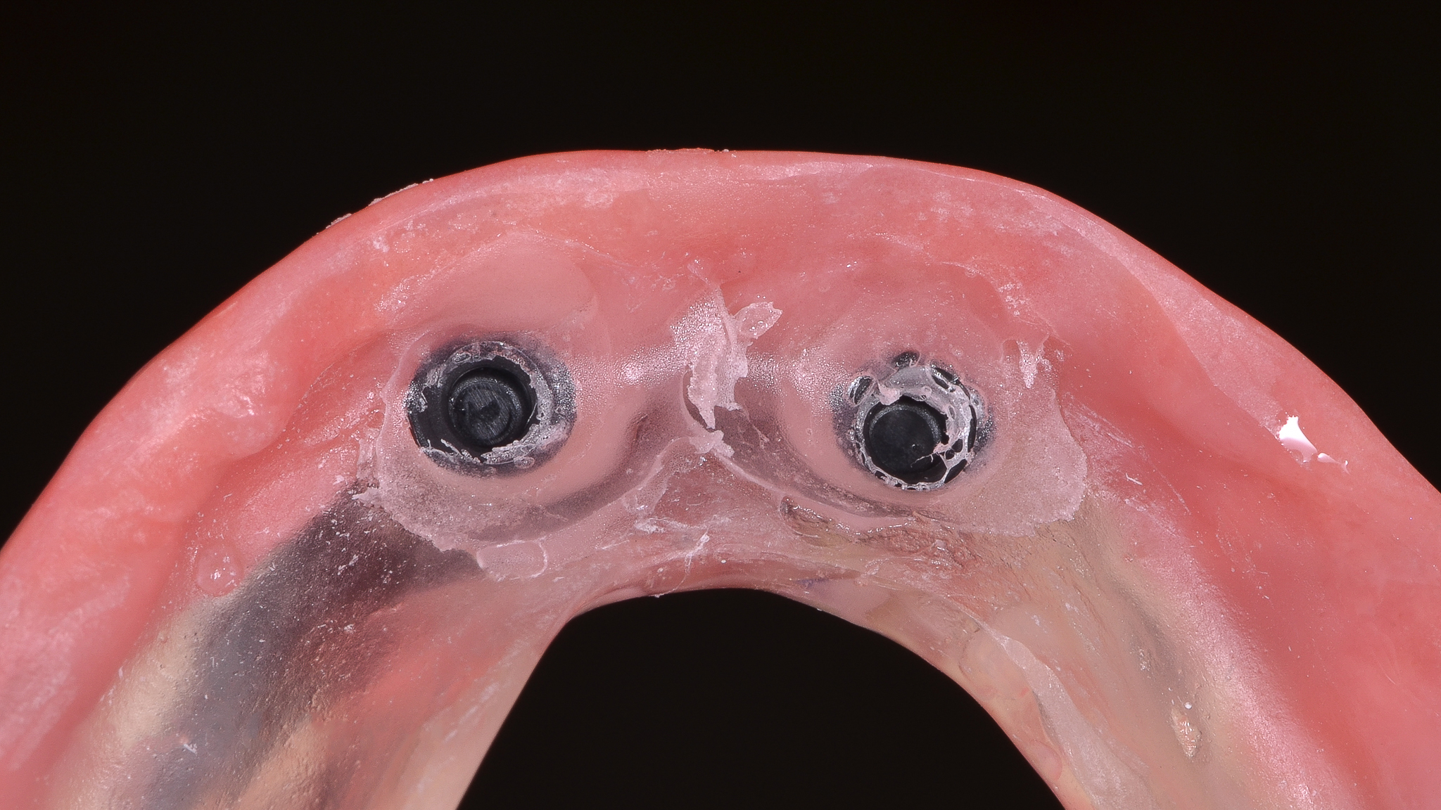 Arteria antral 08 1 - Prótese Overdenture sobre componentes customizados