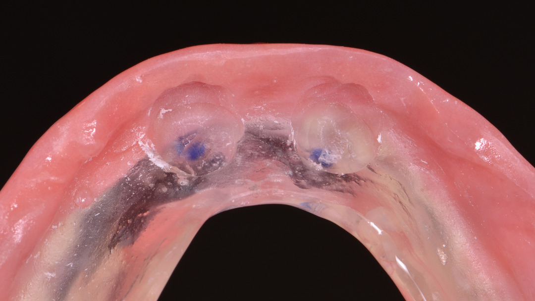 Arteria antral 09 1 - Prótese Overdenture sobre componentes customizados
