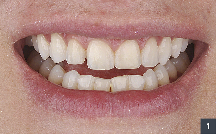 01 - Allcem Veneer - Cemento