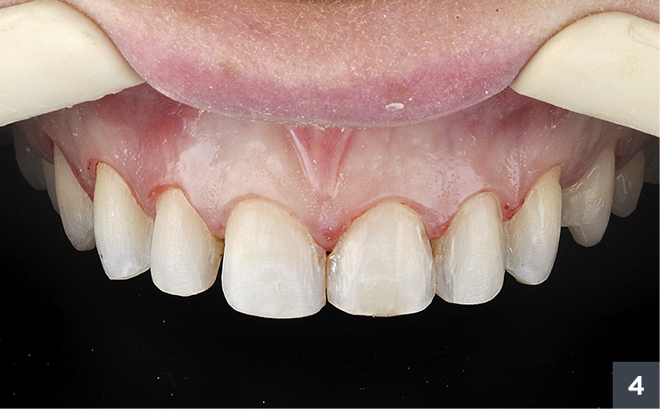 04 - Allcem Veneer - Cemento