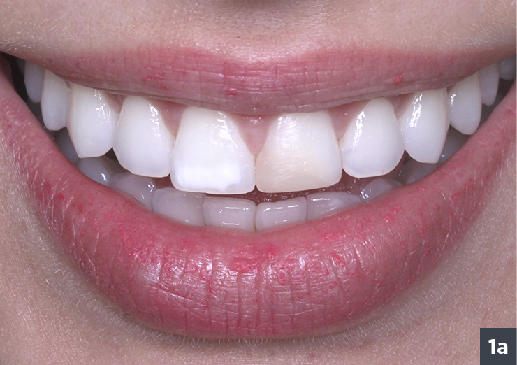 1 inicial sorriso - Vittra APS - Estetica Premium
