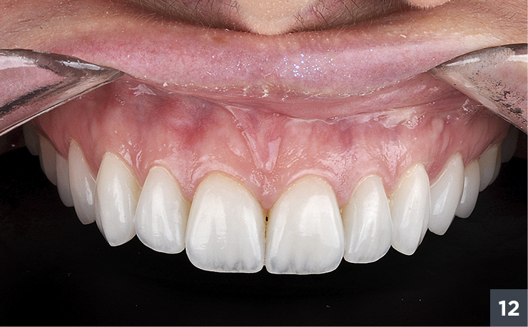 16 - Allcem Veneer - Cemento