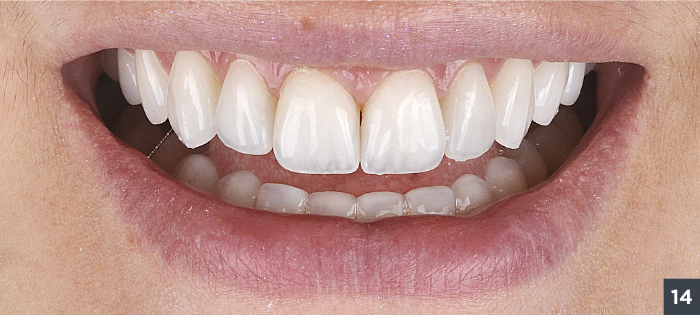 18 - Allcem Veneer - Cemento